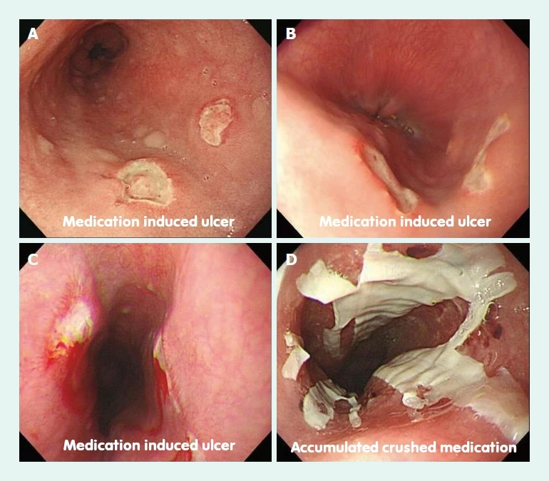 Images showing medication-induced oesophagitis and accumulated crushed medication